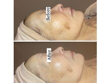 ルヴィカカリーナ(REVI Cacalena)/