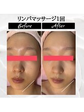 ポムポムボナー/ハリ/毛穴/小顔/美白同時改善♪