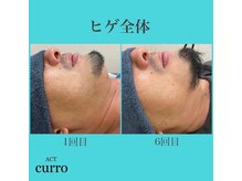 アクト クロ(ACT curro)/【ヒゲ脱毛】脱毛施術例