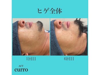 アクト クロ(ACT curro)/【ヒゲ脱毛】脱毛施術例