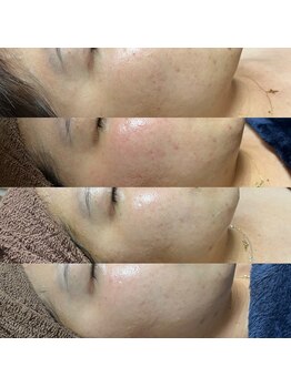 シエル 美里店(ciel)/Revi☆陶肌トリートメント