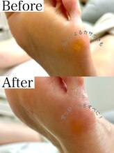 シンデレラジェル(シンデレラGEL)/足裏角質ケア