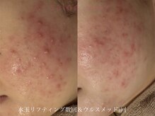 サロンヴェアリー 広尾(salon vary)/水玉リフティング＆ウルスメッド