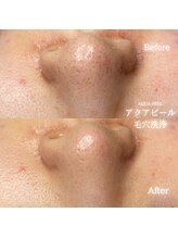 リル 和歌山市店(lilou)/アクアピール毛穴洗浄