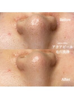 リル 和歌山市店(lilou)/アクアピール毛穴洗浄