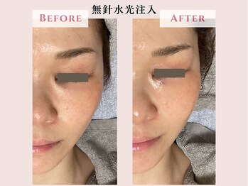 レクラ バイ ドクターエイチ(L'ECLAT by Doctor.H)/無針水光注入”美容液真皮導入”