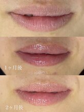 OBS新潟整骨院/ローマピンクで赤ちゃん唇