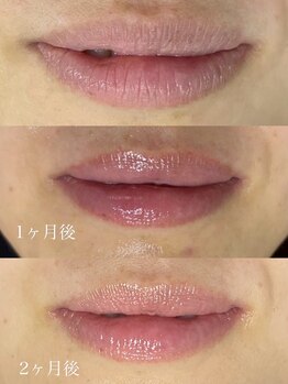 OBS新潟整骨院/ローマピンクで赤ちゃん唇