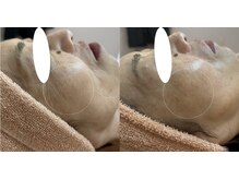 ミュー 多治見店(mieux)/◆肌質改善例