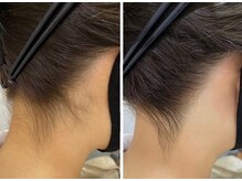 リンダ(Linda)/シェービングの効果は1回でも◎