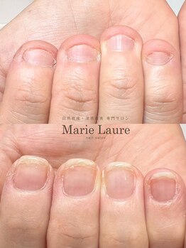 マリーロール 梅田店(Marie Laure)/自爪育成/深爪矯正/ネイルケア