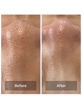 ブールドネージュ(Boule de Neige)/毛穴洗浄ハイドロフェイシャル