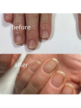 マニュコクーン(ManuCocoon)/爪育成 深爪 巻き爪 大阪市