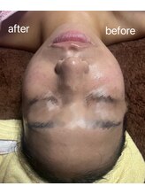 ヤン リン 整体(Yang Ling 整体)/ラジオ波でむくみスッキリ♪