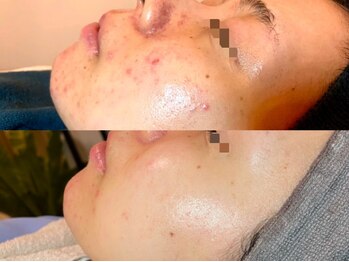 ピブ(PIBU)/ニキビ症例/ハーブピーリング