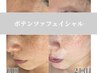 シミ改善×美白集中ケア◎ポテンツァフェイシャル¥29,800→¥16,500