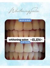 エレン 高槻店(ELEN)/ 歯をレベルUPさせませんか？