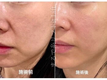 ウルリア(URURIA)/リフトアップ ビフォーアフター