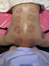 ミッシュ(Mish)/ラジオ波カッピング