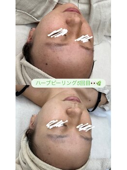 メリアミーゴ(Meli amigo)の写真/当店人気ナンバー1！ニキビレス透明感あふれるつるすべ美肌には☆国産100％ハーブピーリング￥6000