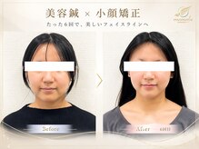メモラ(memola)/美容鍼