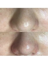 ミーミー 多治見店(MeMe.)/毛穴エクストラクション