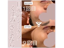 パルティノ 高崎店/エクソソームフォト光エステ