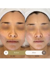 プラウド(Proud)/ケア症例/プラズマケア　4回