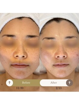 プラウド(Proud)/ケア症例/プラズマケア　4回