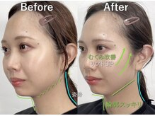 ラプリ 大宮店(Raplit)/隆鼻＋輪郭矯正40分10回