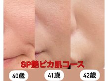 美肌総合ケアの２年の経過↑本来の美しさを引き出す肌管理に♪