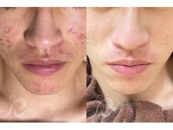 エルビービュティーサロン(LB BEAUTY SALON)/【ニキビ改善】ハーブピーリング