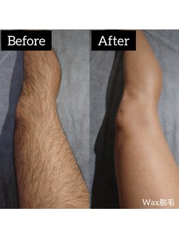 ジュゴン(Dugong)/足脱毛（Before＆After）