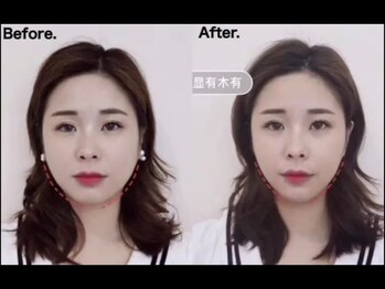 ゆうき式小顔矯正/小顔矯正before&after