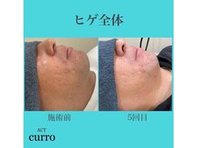 アクト クロ(ACT curro)/【ヒゲ全体】脱毛施術例