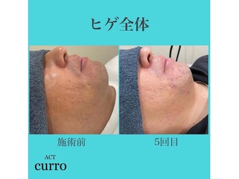 アクト クロ(ACT curro)/【ヒゲ全体】脱毛施術例