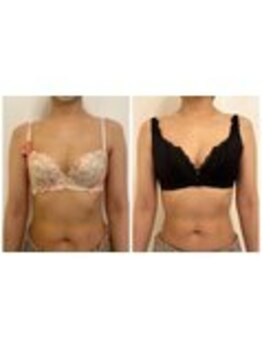 美人バスト 表参道店/【バストアップ/育乳 症例】