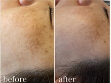 グレイティア(gratia)/韓国肌管理ララピール