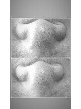 ナナラ(NANALA)/諦めてた毛穴の黒ずみ