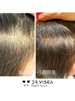 リジューブ(Rejuve)/