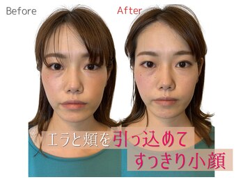 小顔製作所 心斎橋院/小顔矯正　施術実例２