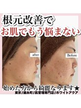 ホワイトアクア 錦糸町店(WHITE AQUA)/ハーブピーリング/東京/錦糸町