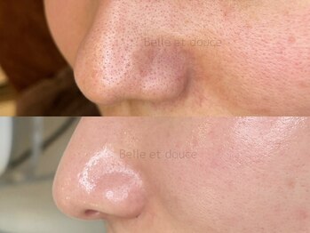 ベルエドゥース(Belle et Douce)/毛穴の開き症例