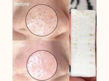 産毛も不要な角栓も取るWAX脱毛♪美白も叶っちゃう♪