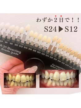 ブリエ(BRILLER)/《医》通常ホワイトニング症例