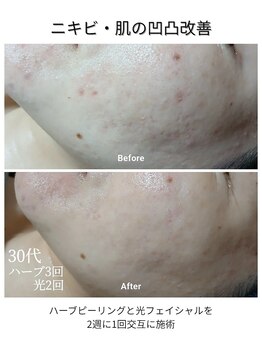 ベルクラージュ(Belle Courage)/30代　肌の凹凸