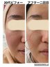 【毛穴ケアをしたい】触るとザラザラするお悩みの方へ!超音波×美容液導入