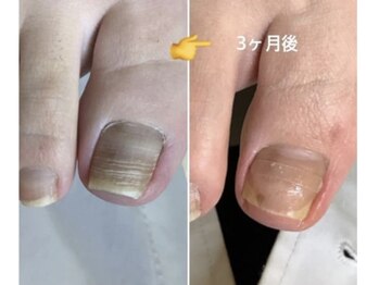 リゼラアンドコー 宇都宮店/巻き爪矯正♪B/Sスパンゲ