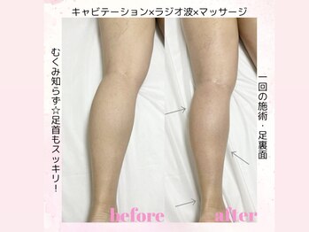 カラン(Calin)/キャビ＋ラジオ波＋マッサージ