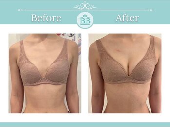 美人バスト 赤羽店/バストアップ・バストケア症例★